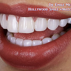 Composite Veneers Lebanon