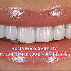 Composite Veneers Lebanon