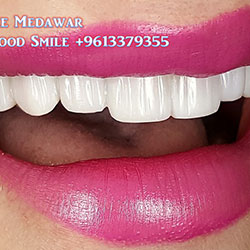 Composite Veneers Lebanon