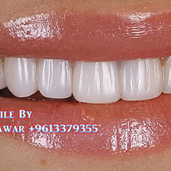 Composite Veneers Lebanon
