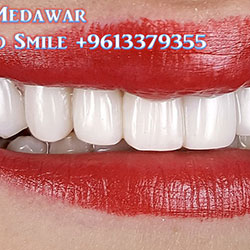 Composite Veneers Lebanon