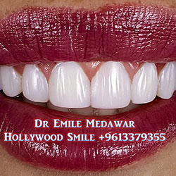 Composite Veneers Lebanon