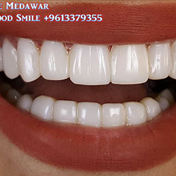 Composite Veneers Lebanon