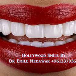 Composite Veneers Lebanon