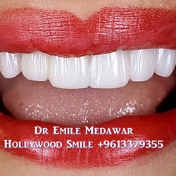 Composite Veneers Lebanon