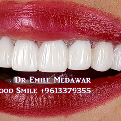 Composite Veneers Lebanon