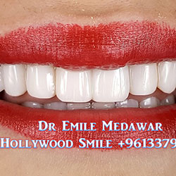 Composite Veneers Lebanon