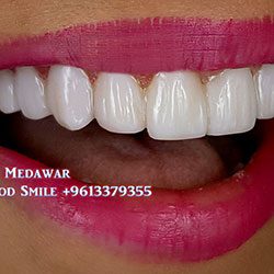 Composite Veneers Lebanon