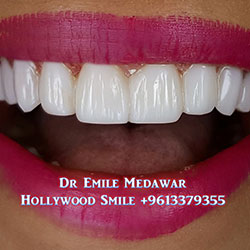 Composite Veneers Lebanon