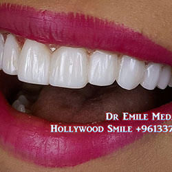 Composite Veneers Lebanon