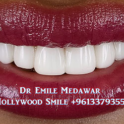 Composite Veneers Lebanon