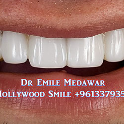 Composite Veneers Lebanon