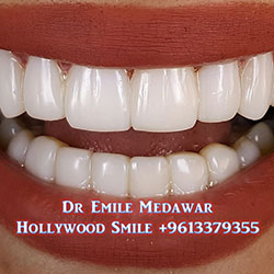 Composite Veneers Lebanon