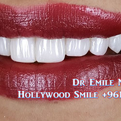 Composite Veneers Lebanon