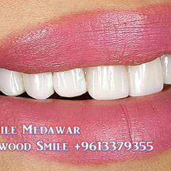 Composite Veneers Lebanon
