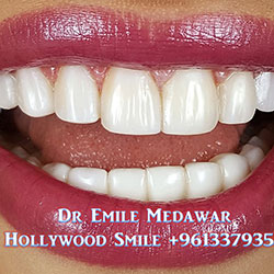 Composite Veneers Lebanon