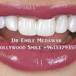 Composite Veneers Lebanon