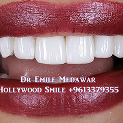 Composite Veneers Lebanon
