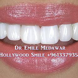 Composite Veneers Lebanon