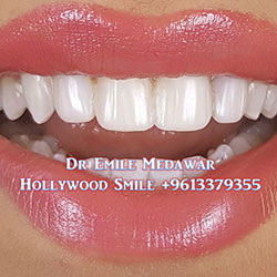 Composite Veneers Lebanon