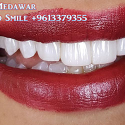 Composite Veneers Lebanon