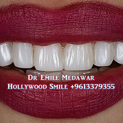 Composite Veneers Lebanon