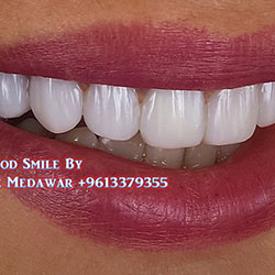 Composite Veneers Lebanon