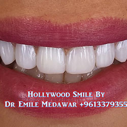 Composite Veneers Lebanon