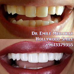 Composite Veneers Lebanon