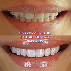 Composite Veneers Lebanon