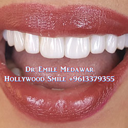 Composite Veneers Lebanon