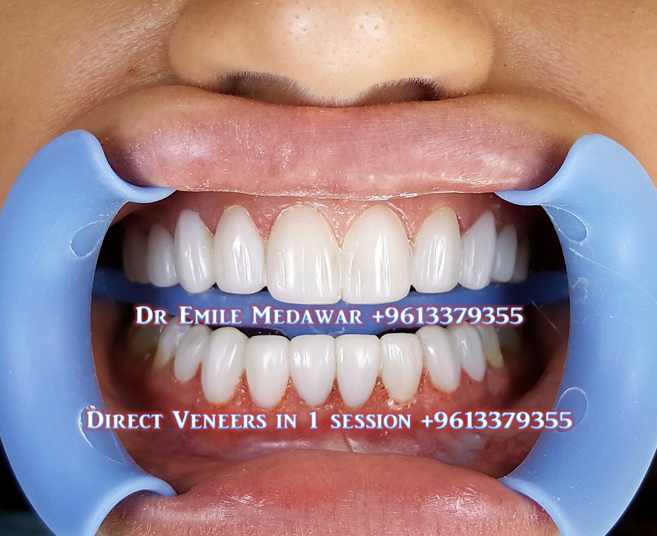 Composite Veneers Lebanon