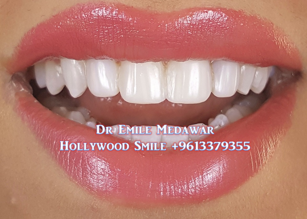 Composite Veneers Lebanon