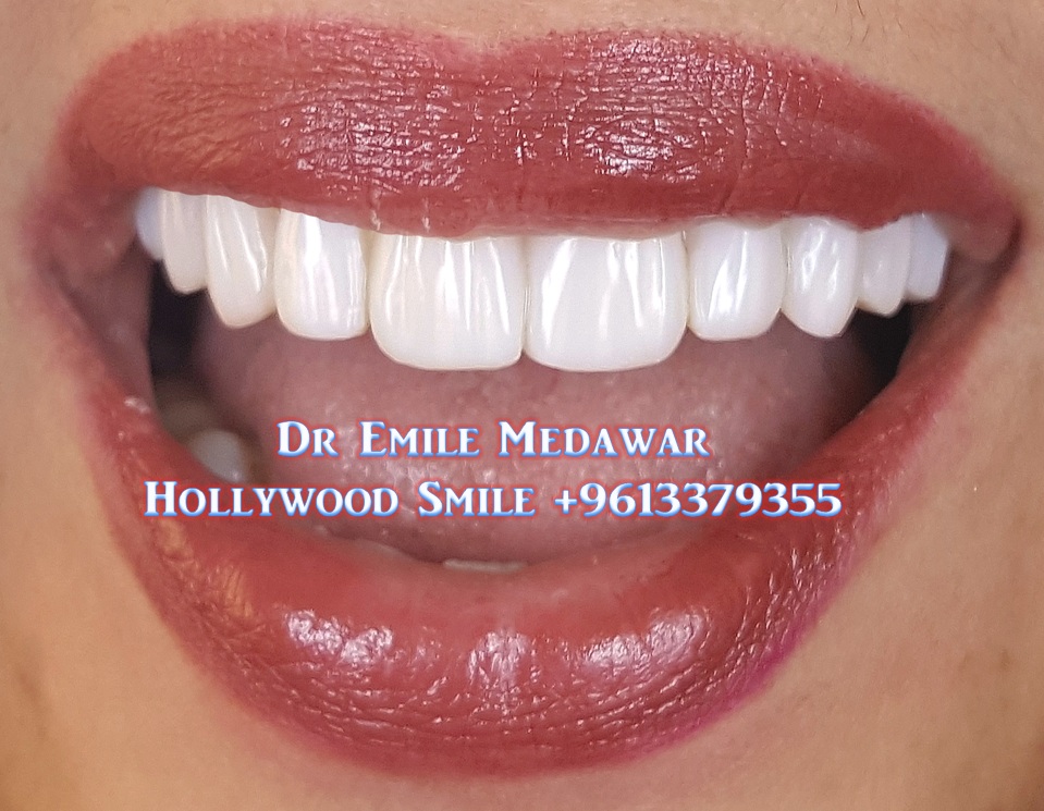 Composite Veneers Lebanon