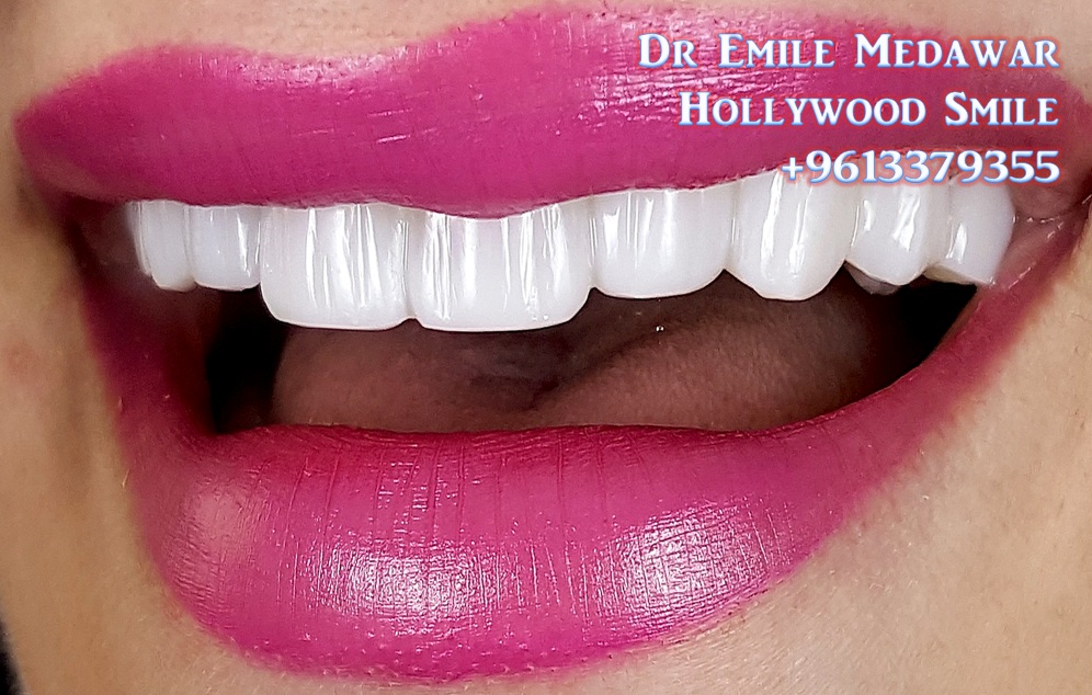 Composite Veneers Lebanon