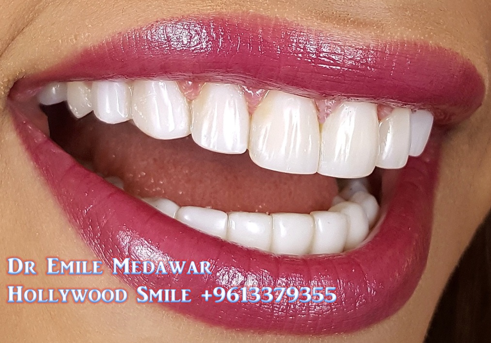 Composite Veneers Lebanon