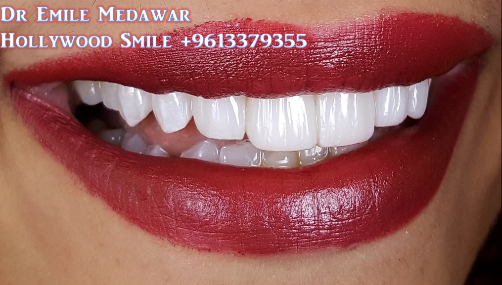 Composite Veneers Lebanon