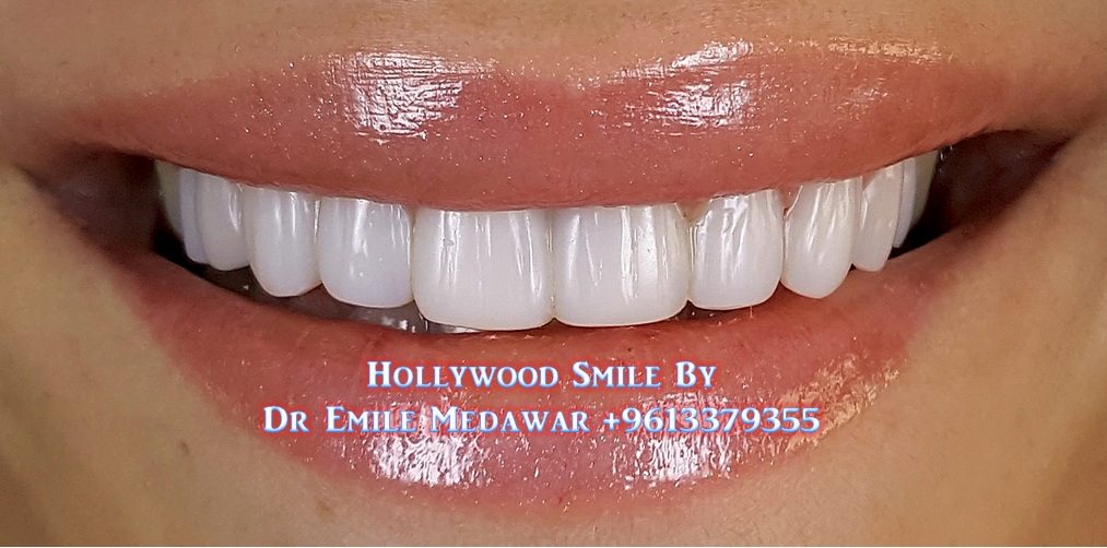 Composite Veneers Lebanon