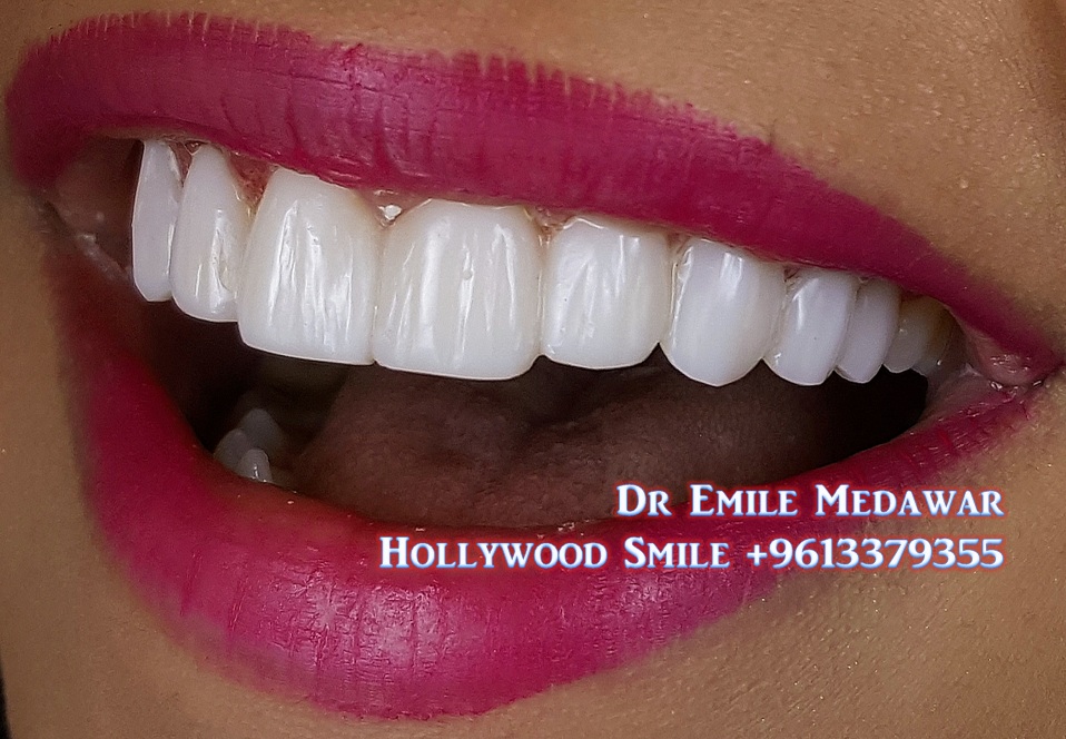 Composite Veneers Lebanon