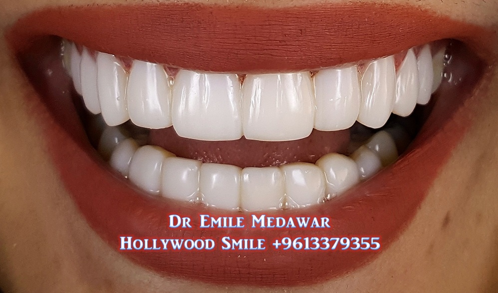 Composite Veneers Lebanon