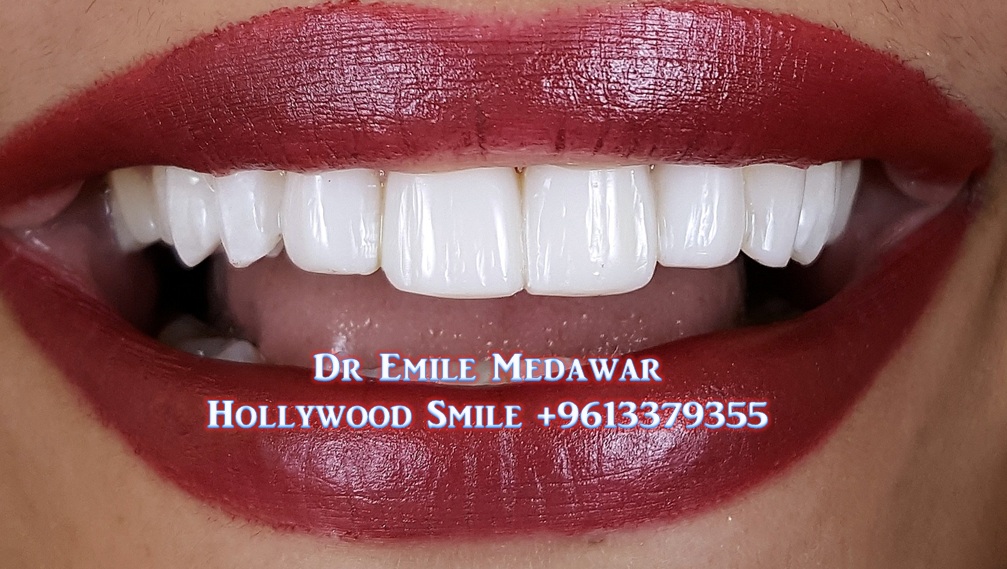 Composite Veneers Lebanon