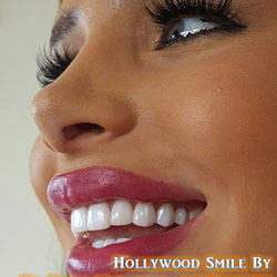 Composite Veneers Lebanon