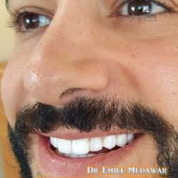 Composite Veneers Lebanon