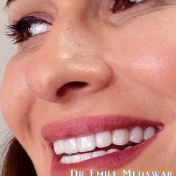 Composite Veneers Lebanon