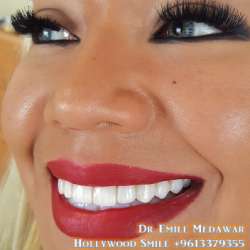Composite Veneers Lebanon