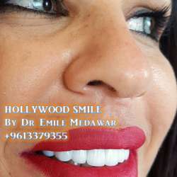 Composite Veneers Lebanon
