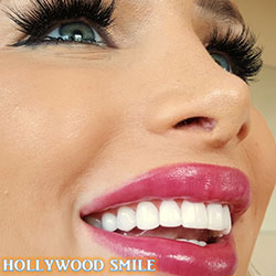 Composite Veneers Lebanon