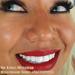 Composite Veneers Lebanon