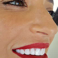 Composite Veneers Lebanon