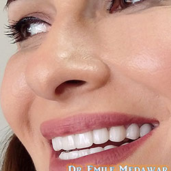 Composite Veneers Lebanon